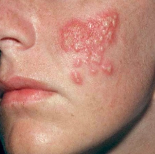 زونا ( Herpes zoster-shingles): معرفی بیماری، علائم، پیش گیری و درمان