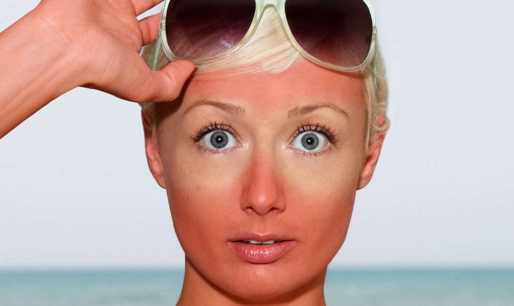 چگونه از آفتاب سوختگی در فصل تابستان جلوگیری کرده و آن را درمان کنیم؟