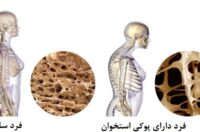 بونیوا برای پوکی استخوان