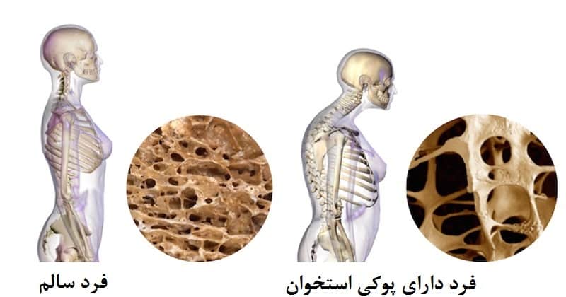 بونیوا برای پوکی استخوان