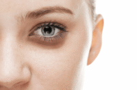 علتهای سیاهی زیر چشم