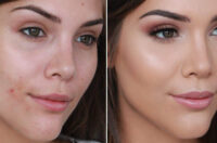 روش صحیح و حرفه‌ای پوشاندن جوش و آکنه به کمک مواد آرایشی