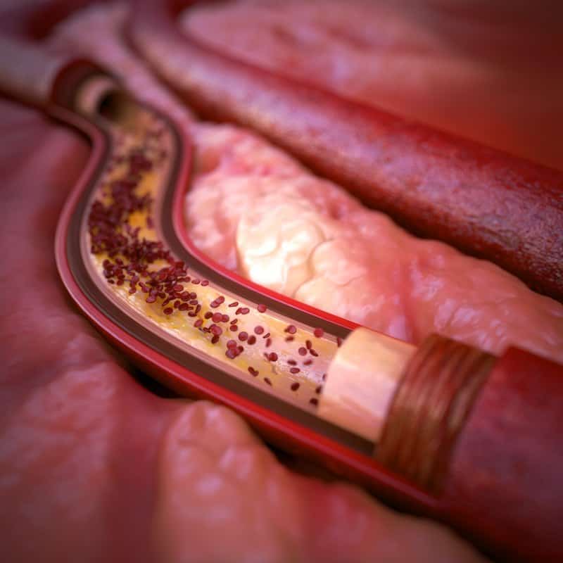 تصلب شرایین (Atherosclerosis) و علل ایجاد، علائم، تشخیص و پیشگیری