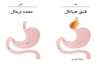 جراحی فتق هیاتال