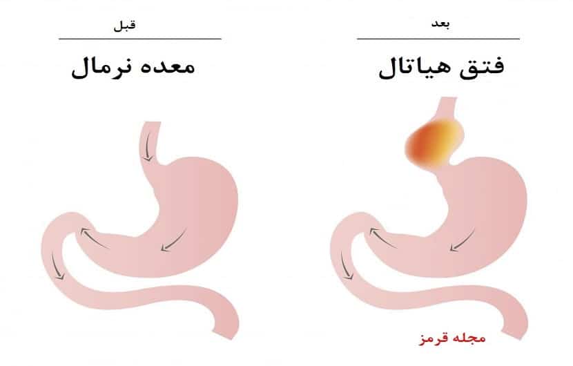 جراحی فتق هیاتال
