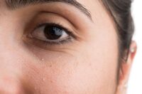 میلیا، علت دانه های ریز سفید روی پوست + درمان آن
