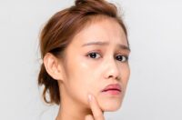 ترفندهای موثر برای از بین بردن جای جوش و آکنه