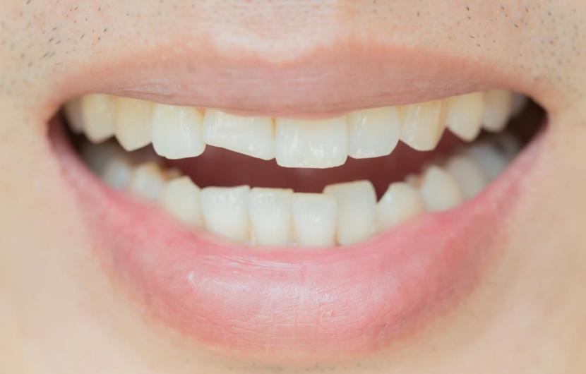 دندان ترک خورده چگونه تشخیص داده شده و ترمیم میشود؟