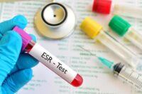 تست ESR آزمایش خون