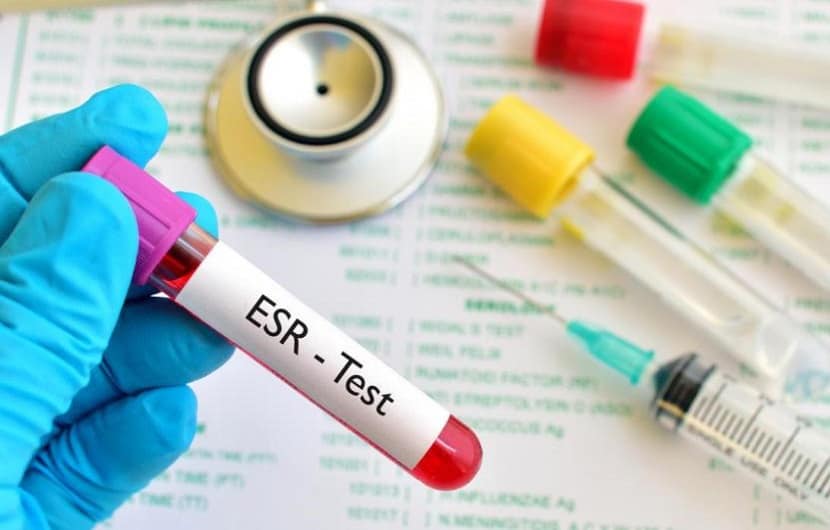 تست ESR آزمایش خون؛ نتایج نرمال و علت نتایج غیر نرمال