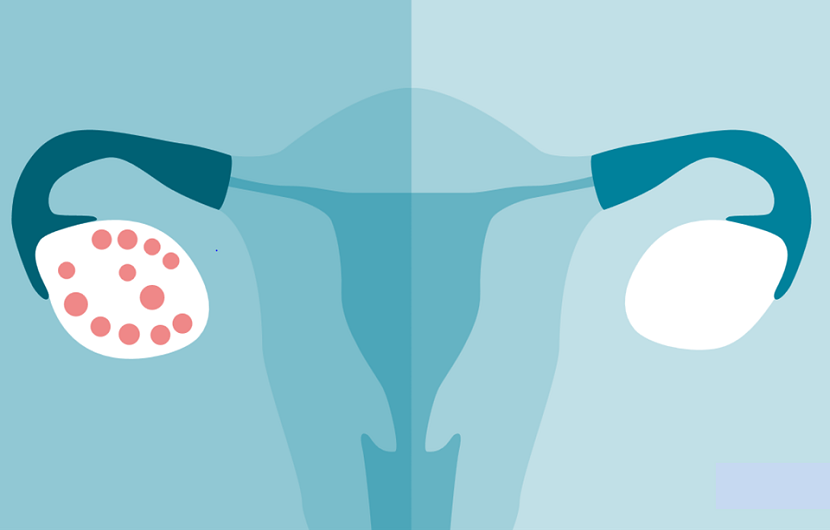 سندرم تخمدان پلی کیستیک (PCOS)؛ علتها، علائم و درمان