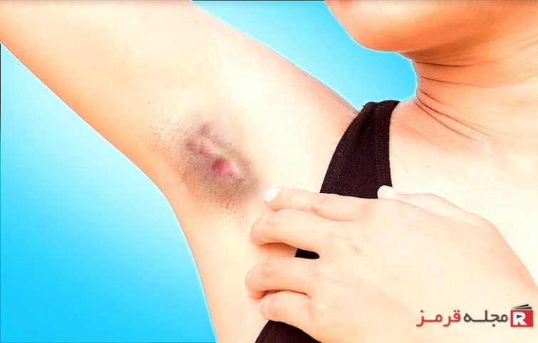 درد زیربغل