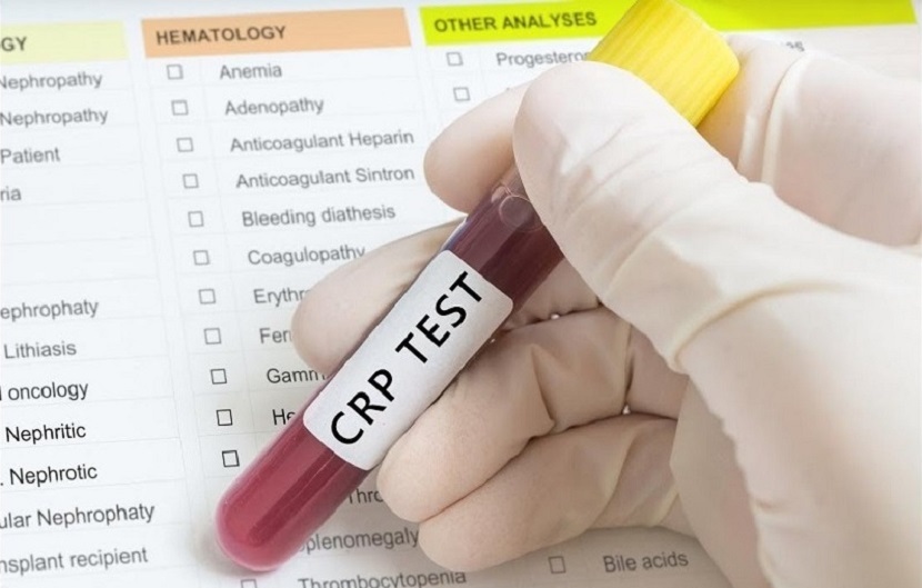 آزمایش CRP یا همان پروتئین واکنشی C چیست و چه کاربرد تشخیصی دارد؟