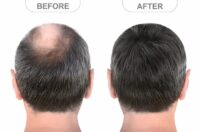 راهنمای دوره آموزش کاشت مو در مشهد