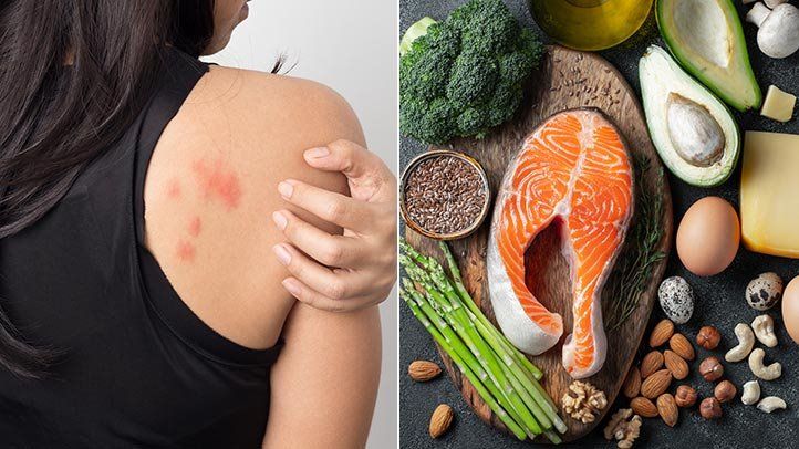 رژیم کتوژنیک و تاثیر عجیب آن بر پوست در کاهش جوش و آکنه + فواید و عوارض