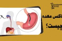 مقایسه بالون معده با بوتاکس معده