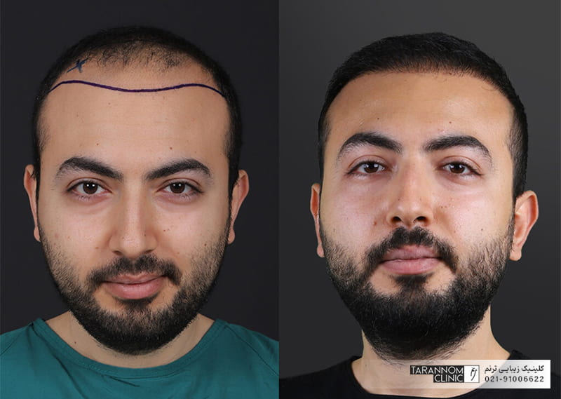 عکس مرد جوان قبل و بعد از کاشت مو