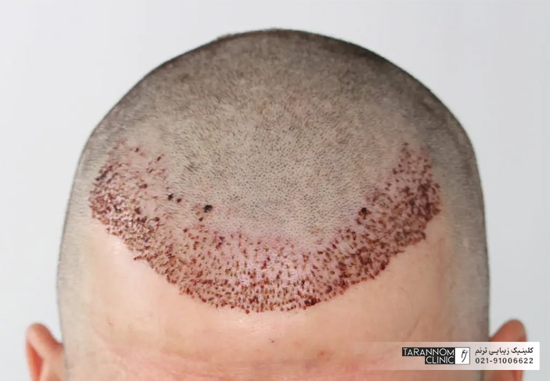 عکس موهای کاشته شده روی سر مرد