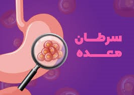 علل و علائم سرطان معده را بشناسید!