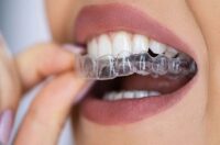 روش های مختلف ارتودنسی نامرئی