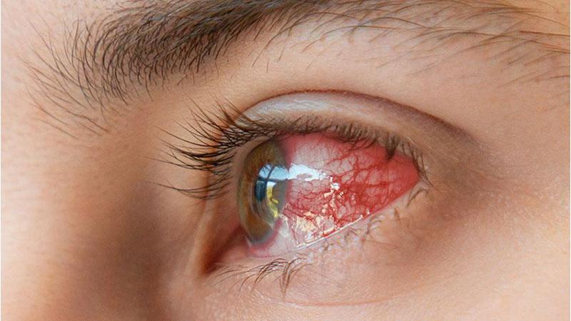 آیا بعد از عمل لیزیک چشم ضعیف می شود؟