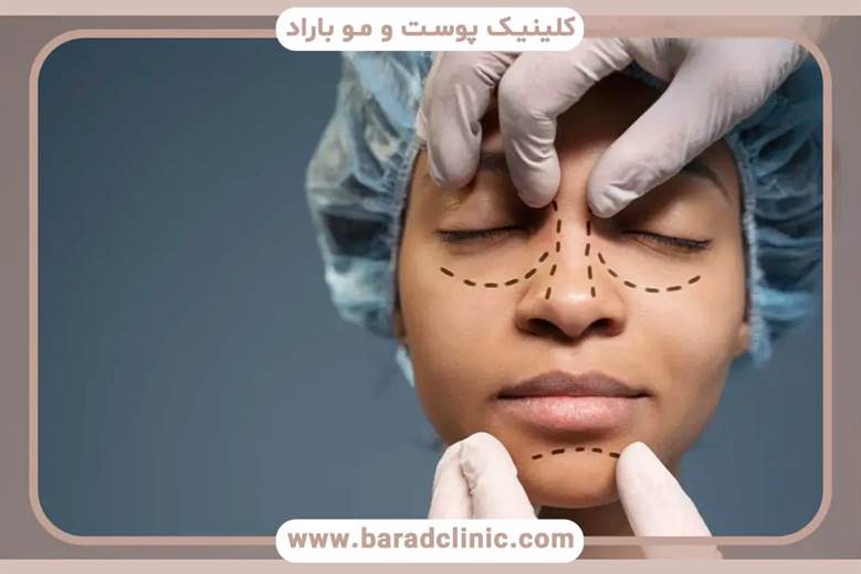 راز چشمانی جذاب بعد از بلفاروپلاستی