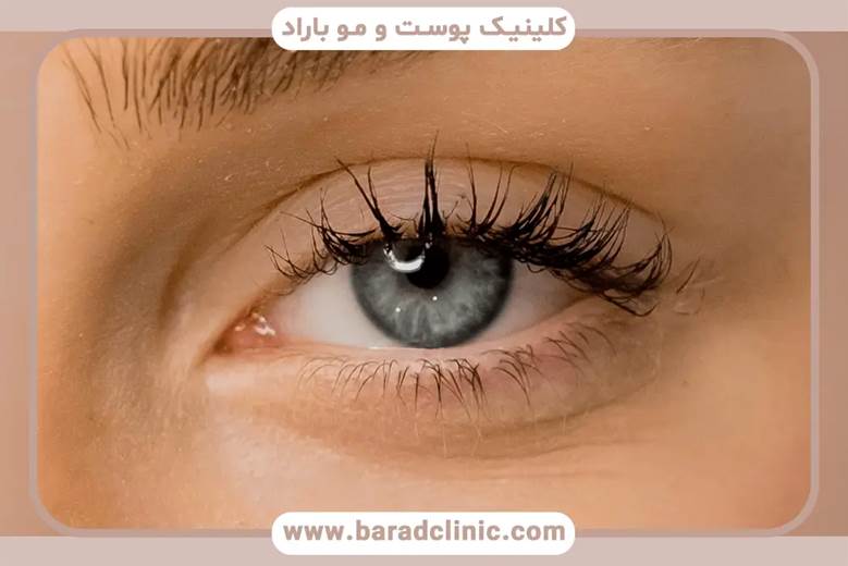 رعایت بهداشت پلکها و جلوگیری از ایجاد عفونت بعد از انجام جراحی پلک