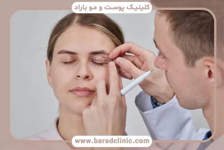 مراقبت از بخیهها و جلوگیری از باز شدن آنها بعد از عمل بلفاروپلاستی