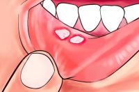 تفاوت آفت دهان و زگیل دهان چیست؟