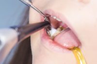 برای رفع پوسیدگی دندان چه کنیم؟ ۶ روش طلایی